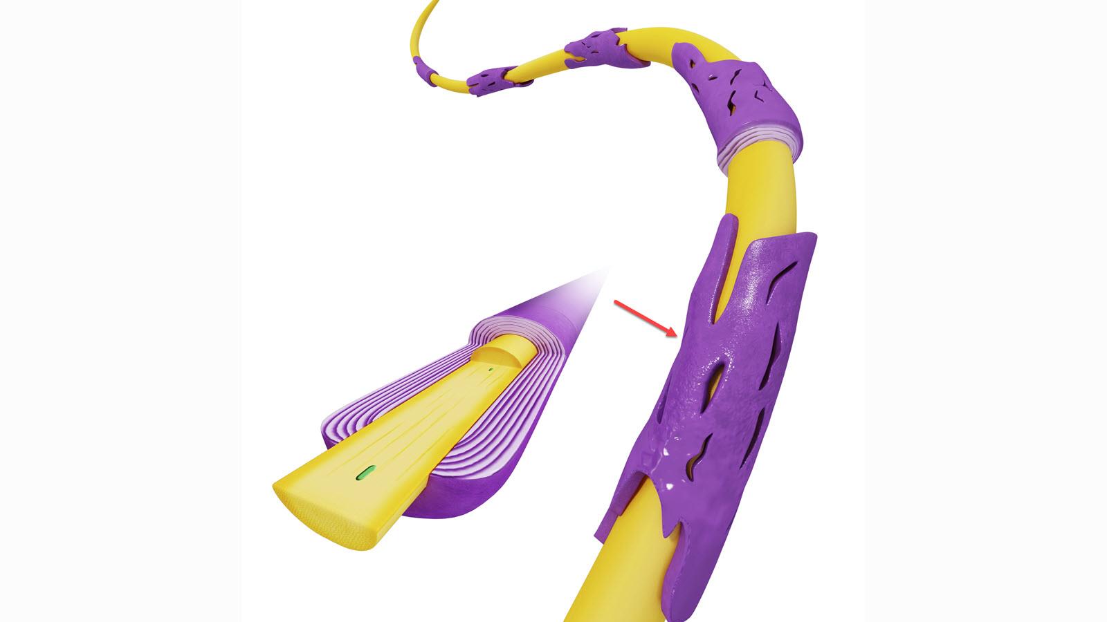Illustration of myelin (shown in purple) covering a yellow nerve