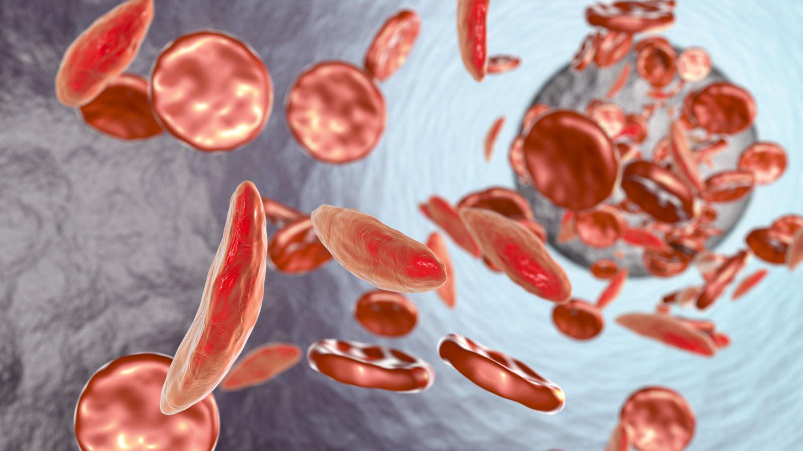 illustration of red sickle cells in the blood stream