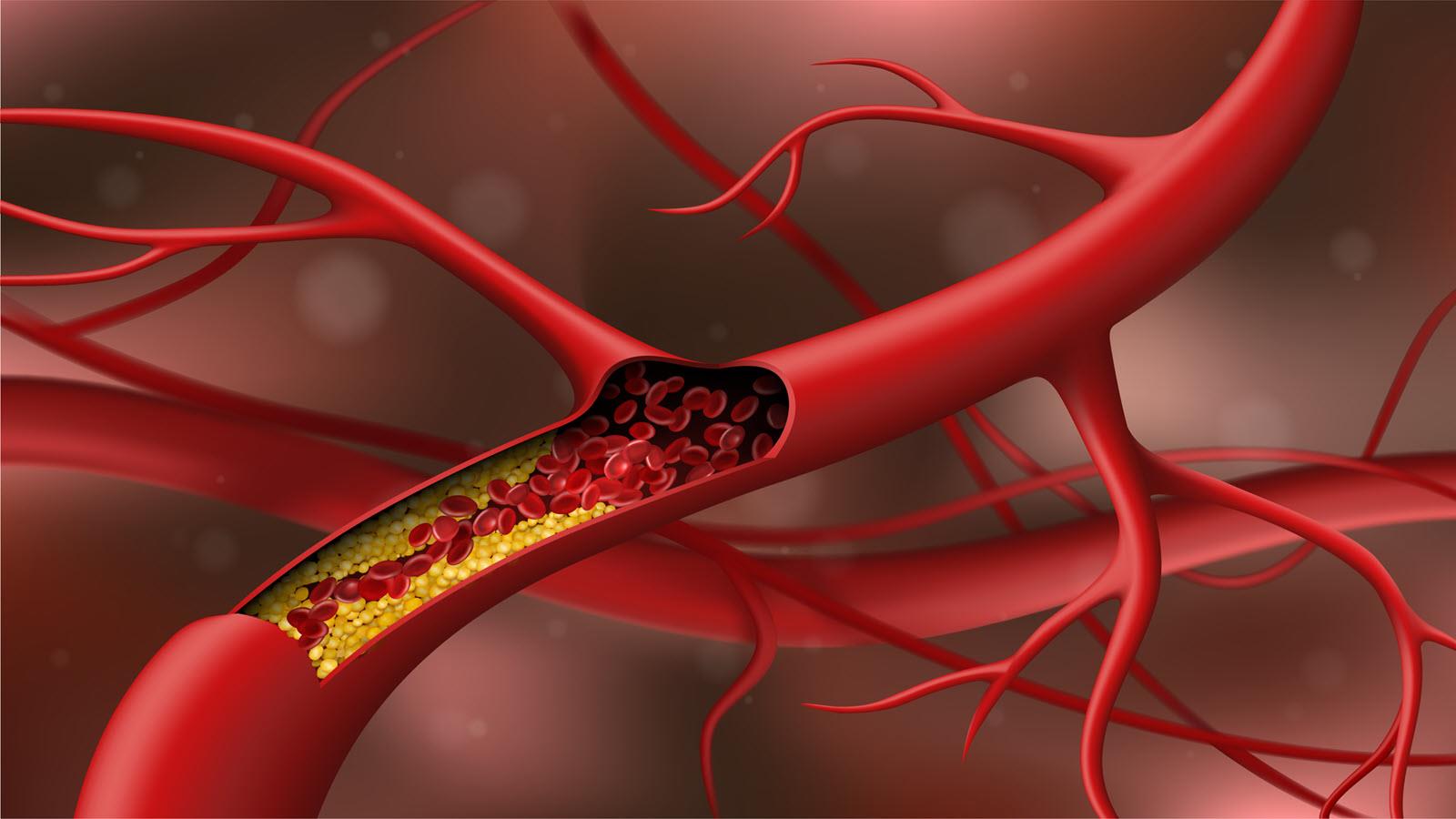 cholesterol in blood vessel