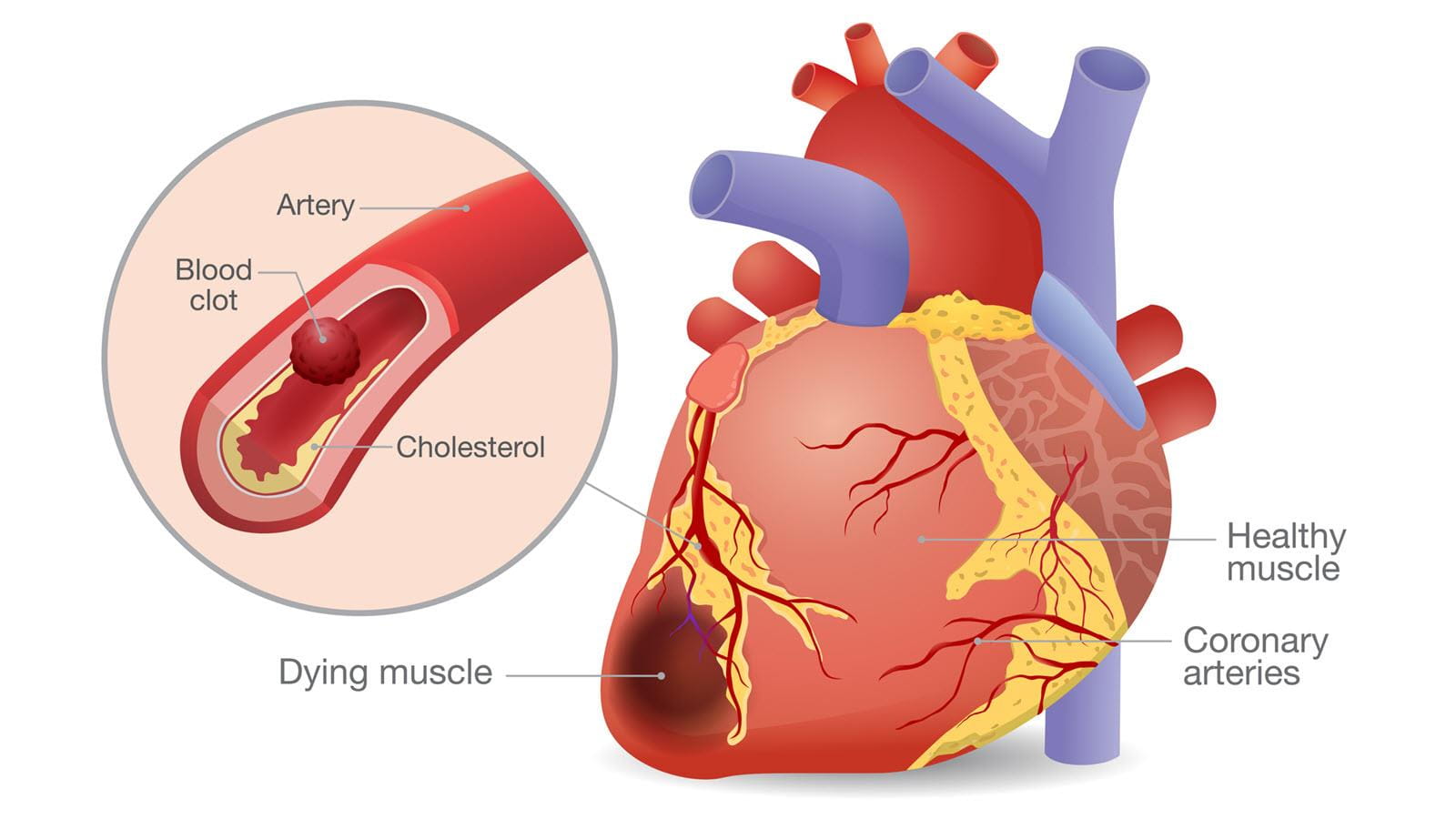 illustration of a heart and the cause of heart attack