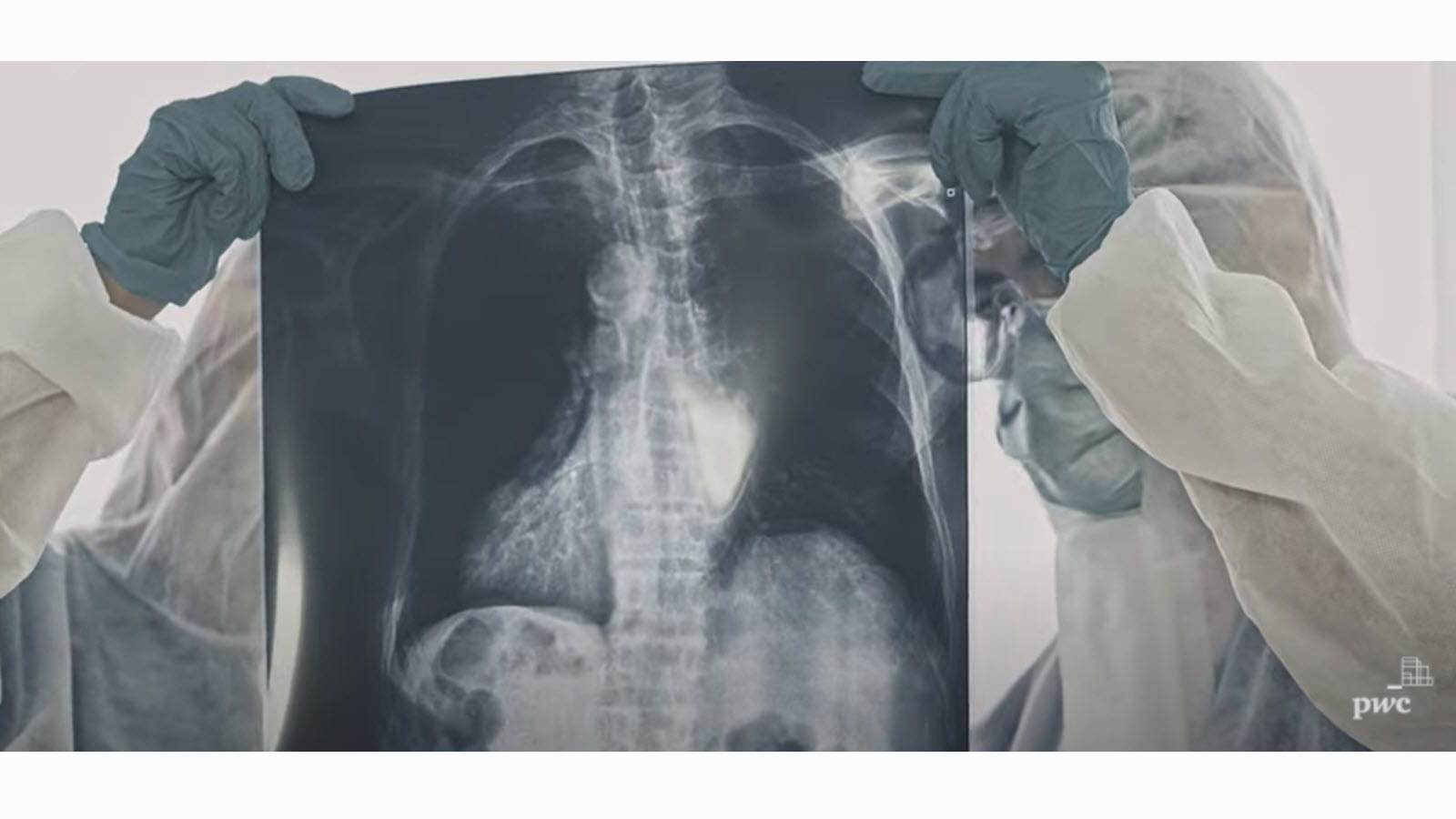 Doctors examine an image of a patient's lungs