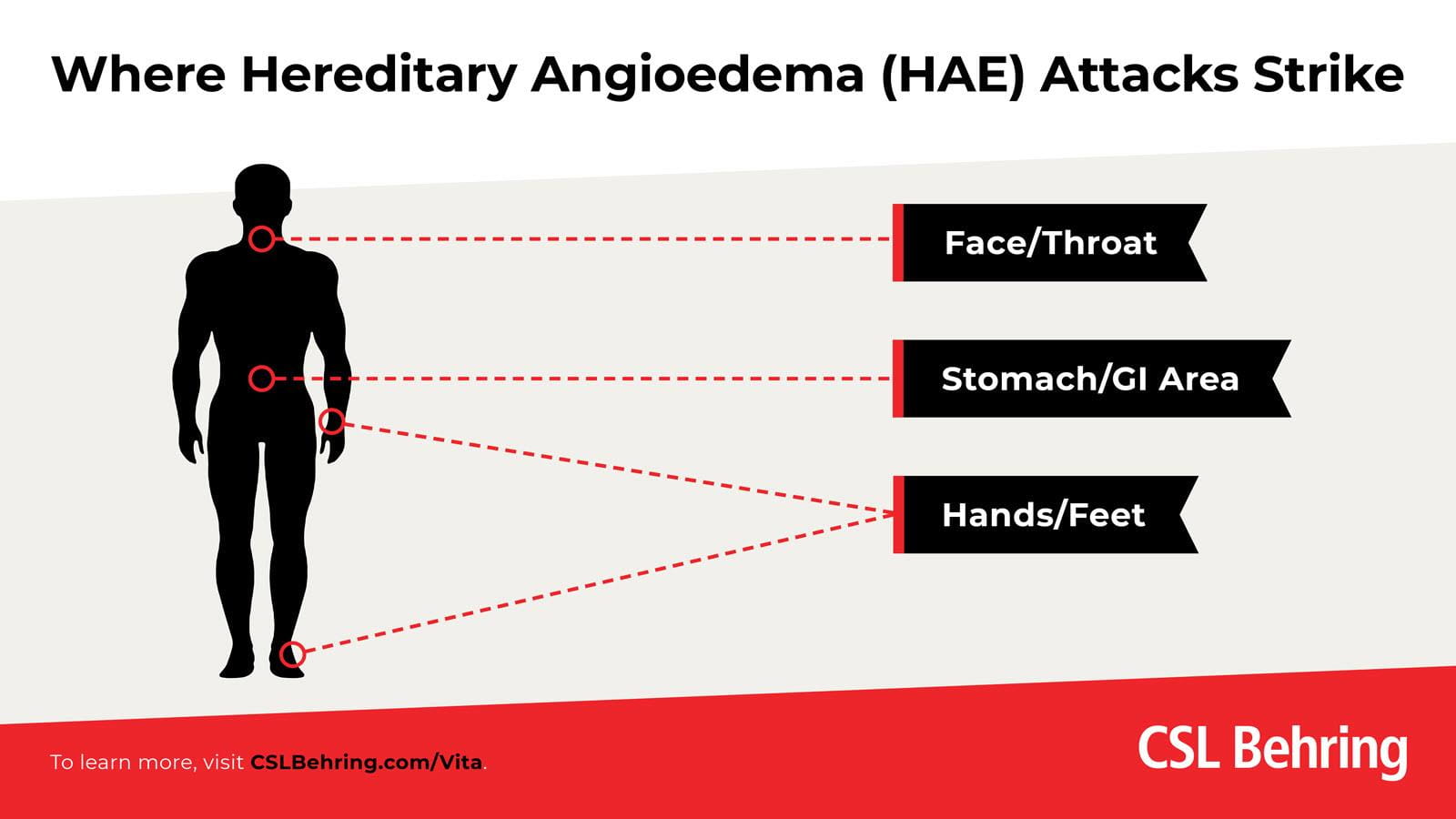 silhouette of human body showing HAE attacks can affect the face/throat, stomach/GI area and hands/feet.
