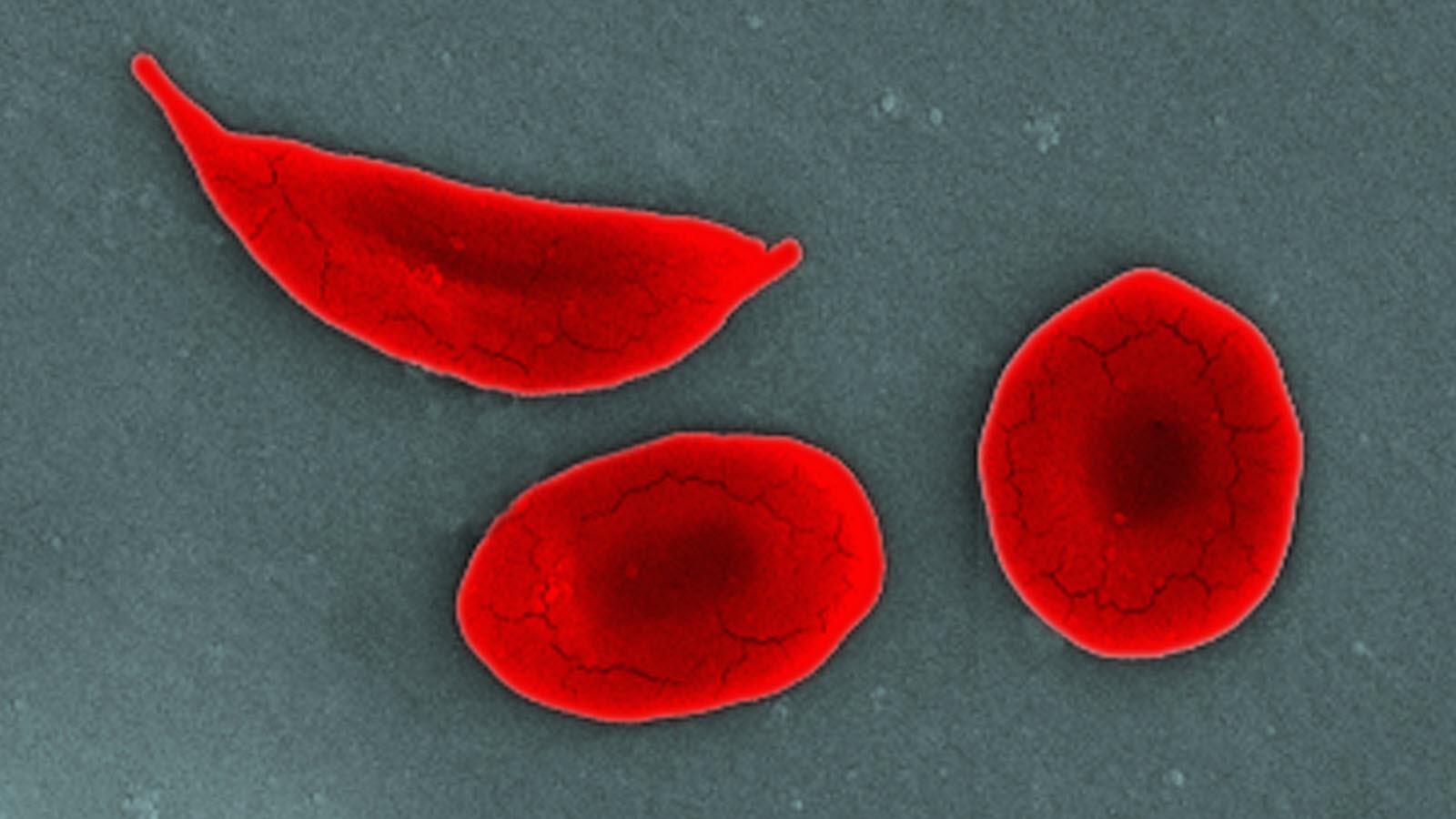 Sickle cell alongside two other red blood cells