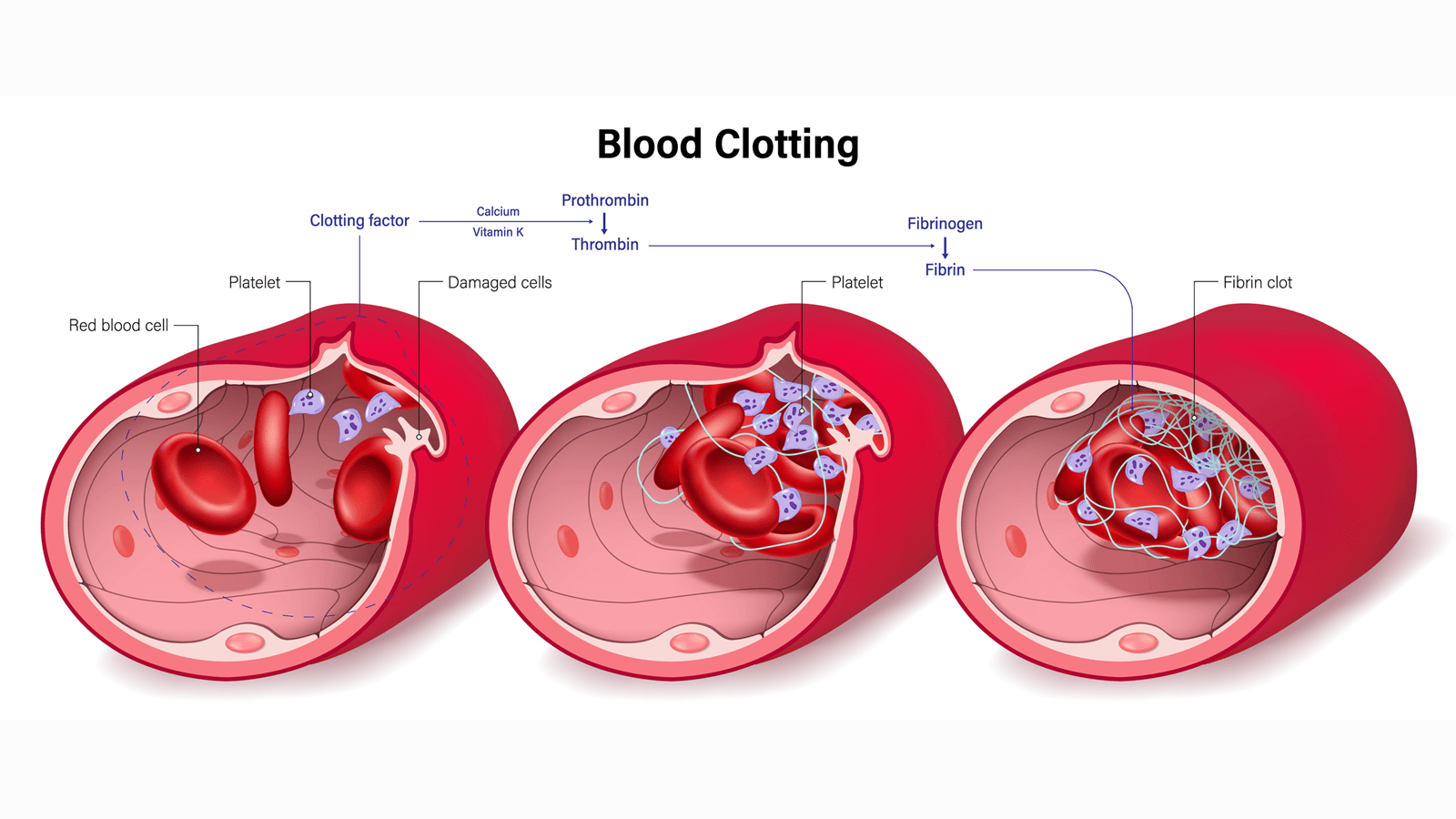 Cross section of three blood vessels showing the process that results in blood clotting