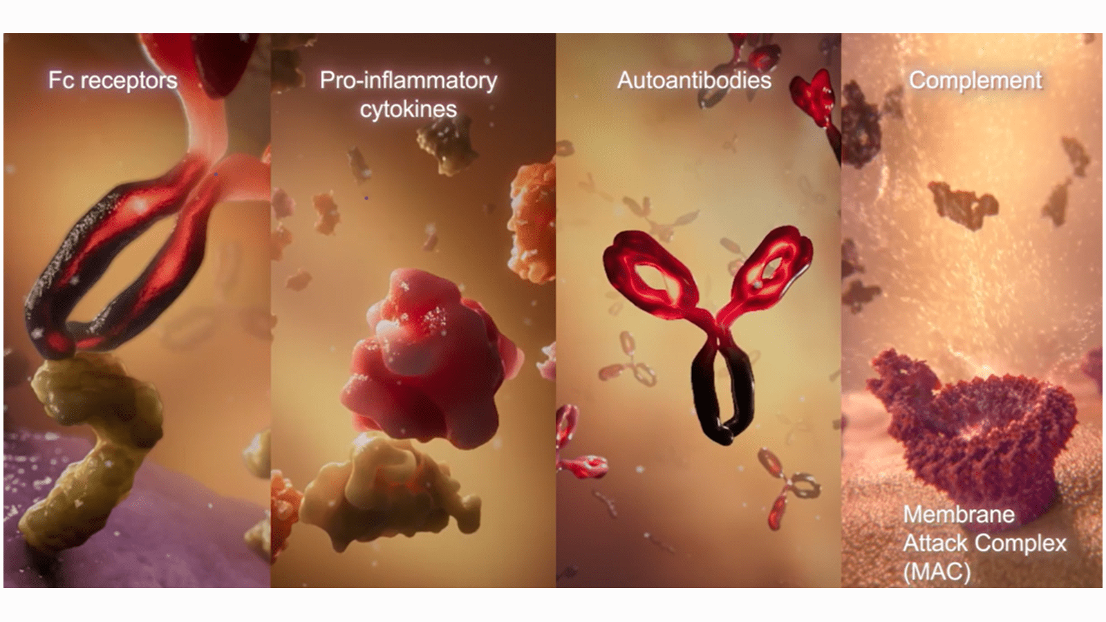 Four panel CIDP image showing Fc receptors; Pro-inflammatory cytokines; Autoantibodies; Complement - Membrane Attack Complex