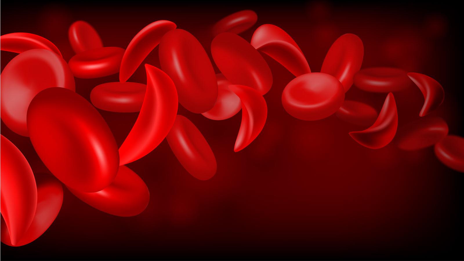 An illustration of normal blood cells along with half-moon-shaped sickle cells