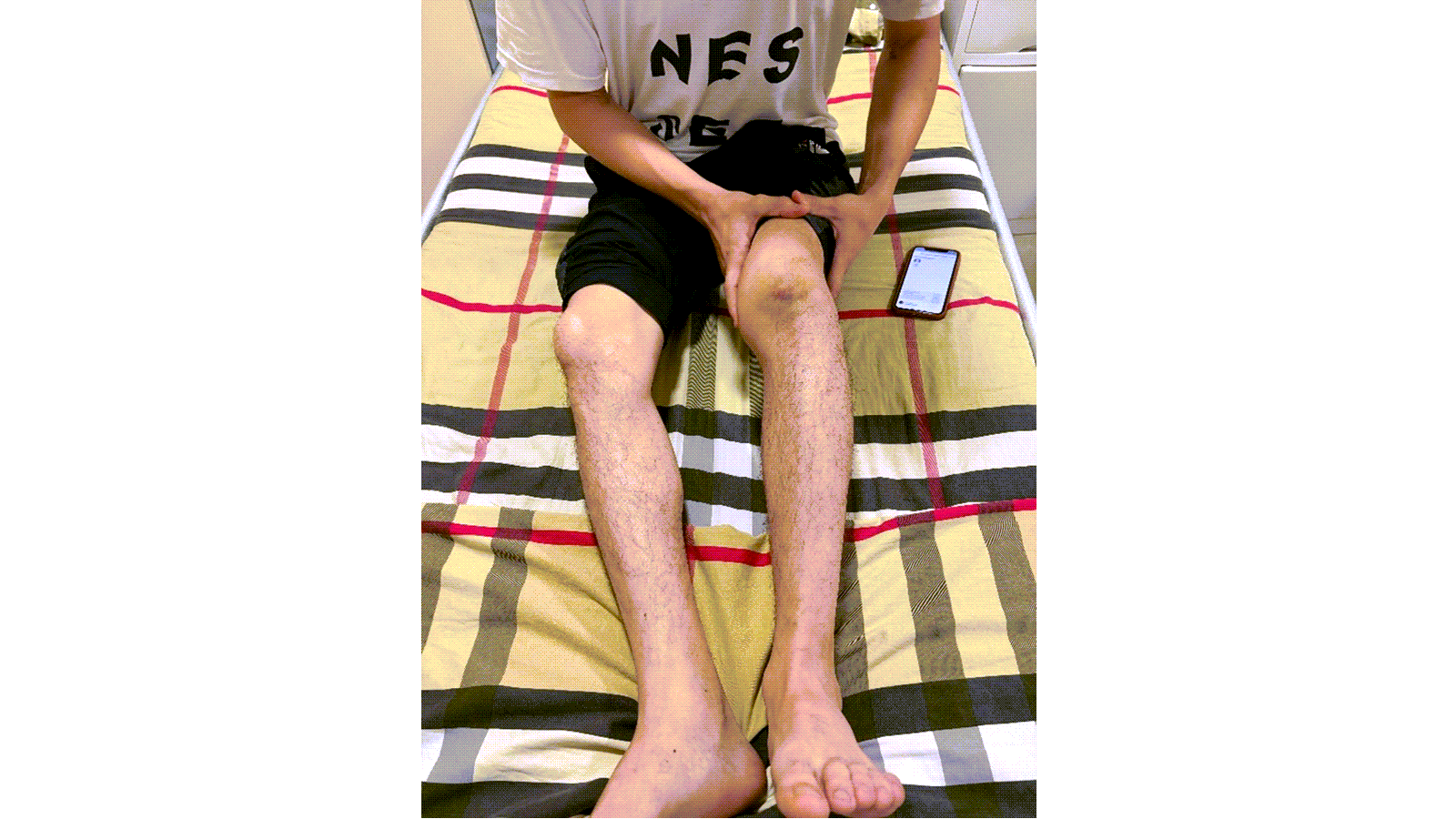 A patient in Uzbekistan whose knee joint has been damaged by hemophilia.